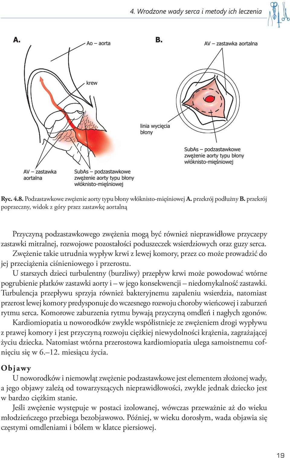 wsierdziowych oraz guzy serca. Zwężenie takie utrudnia wypływ krwi z lewej komory, przez co może prowadzić do jej przeciążenia ciśnieniowego i przerostu.