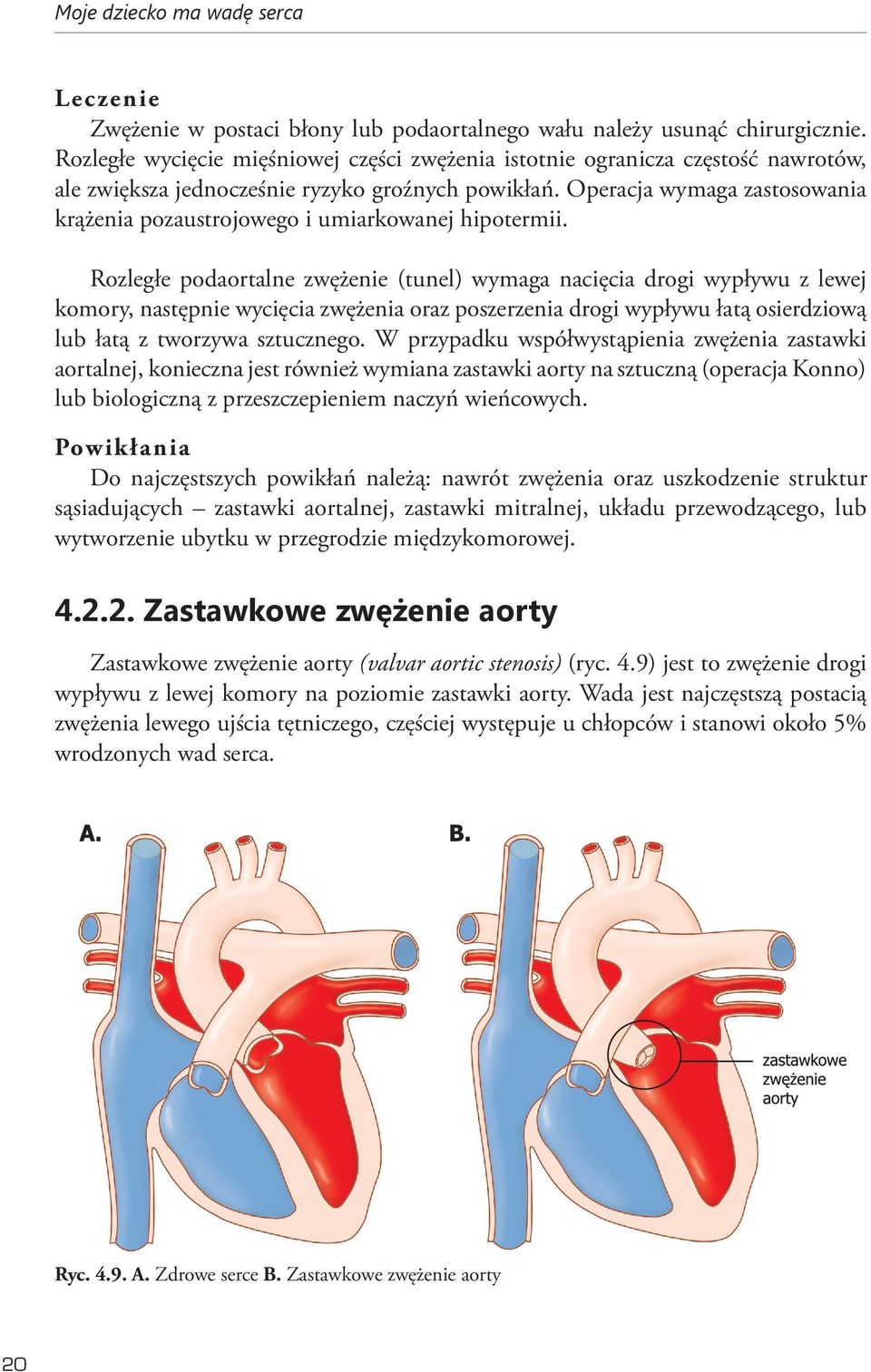 Operacja wymaga zastosowania krążenia pozaustrojowego i umiarkowanej hipotermii.