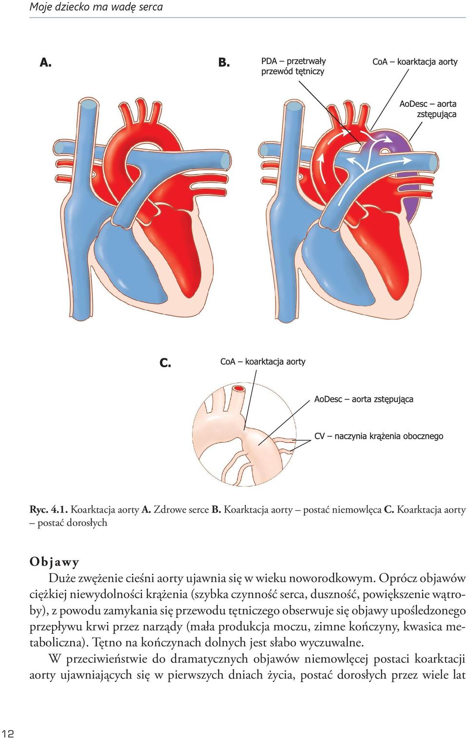 Oprócz objawów ciężkiej niewydolności krążenia (szybka czynność serca, duszność, powiększenie wątroby), z powodu zamykania się przewodu tętniczego obserwuje się objawy