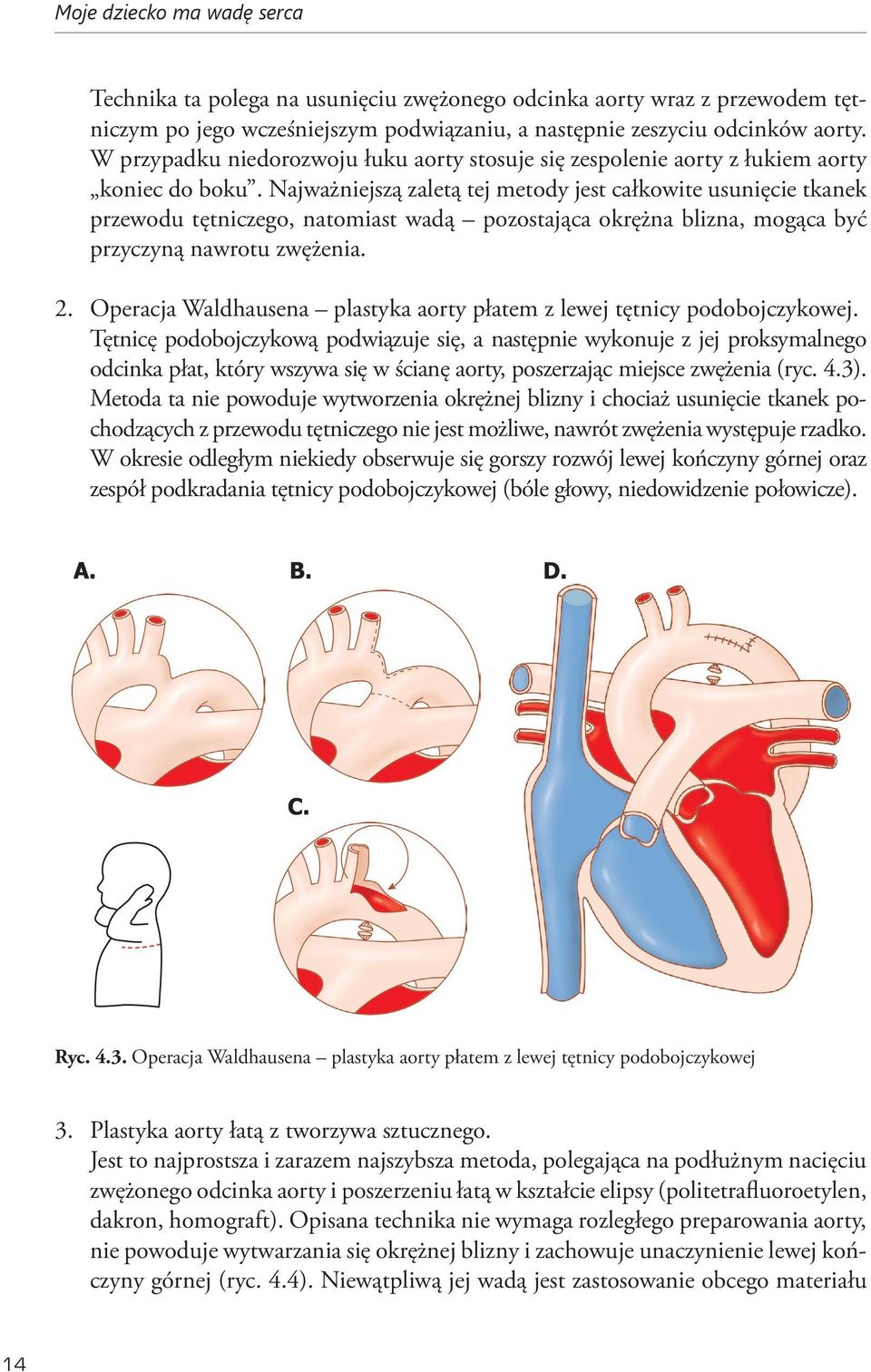 Najważniejszą zaletą tej metody jest całkowite usunięcie tkanek przewodu tętniczego, natomiast wadą pozostająca okrężna blizna, mogąca być przyczyną nawrotu zwężenia. 2.