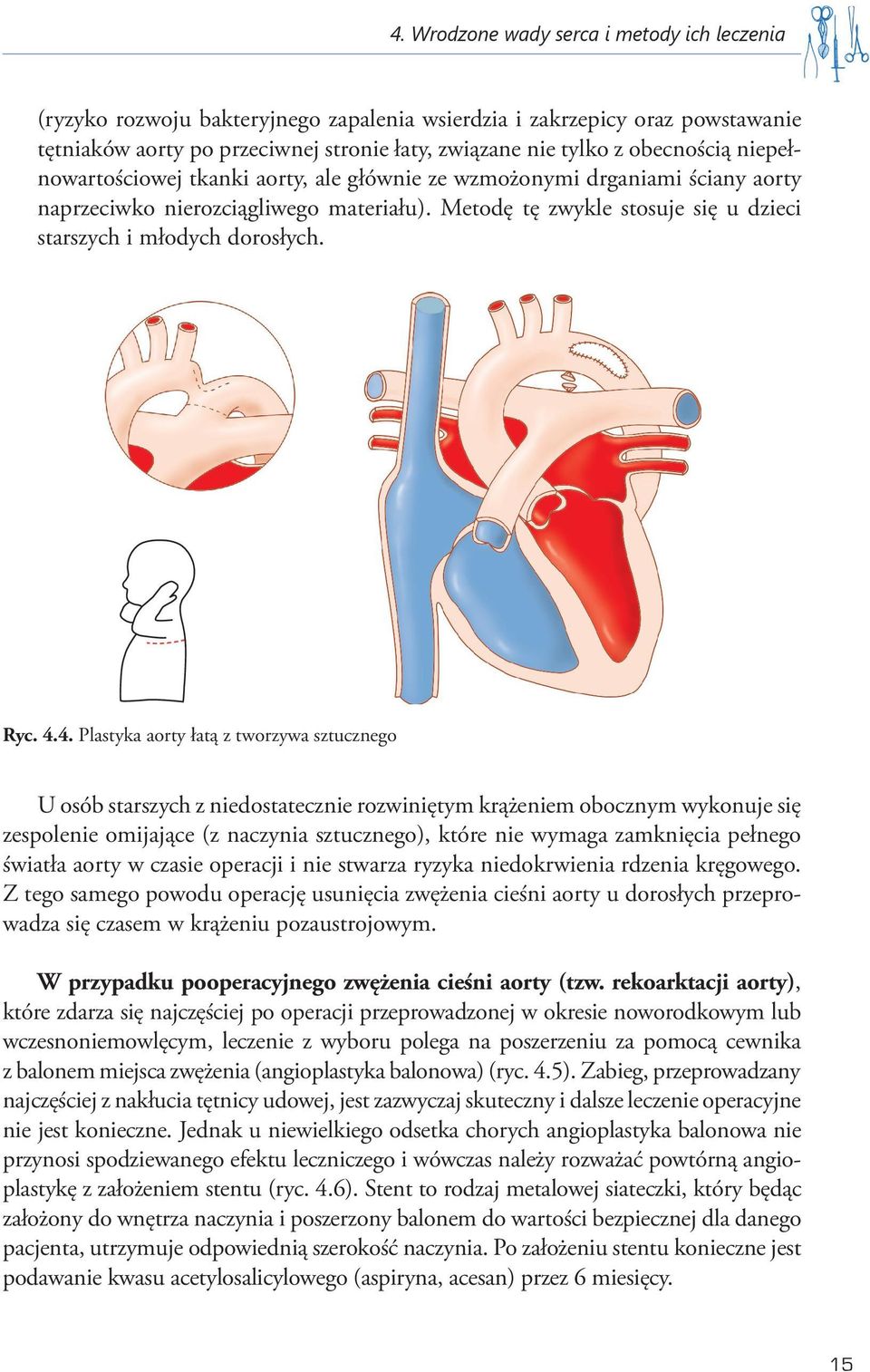 4.4. Plastyka aorty łatą z tworzywa sztucznego U osób starszych z niedostatecznie rozwiniętym krążeniem obocznym wykonuje się zespolenie omijające (z naczynia sztucznego), które nie wymaga zamknięcia