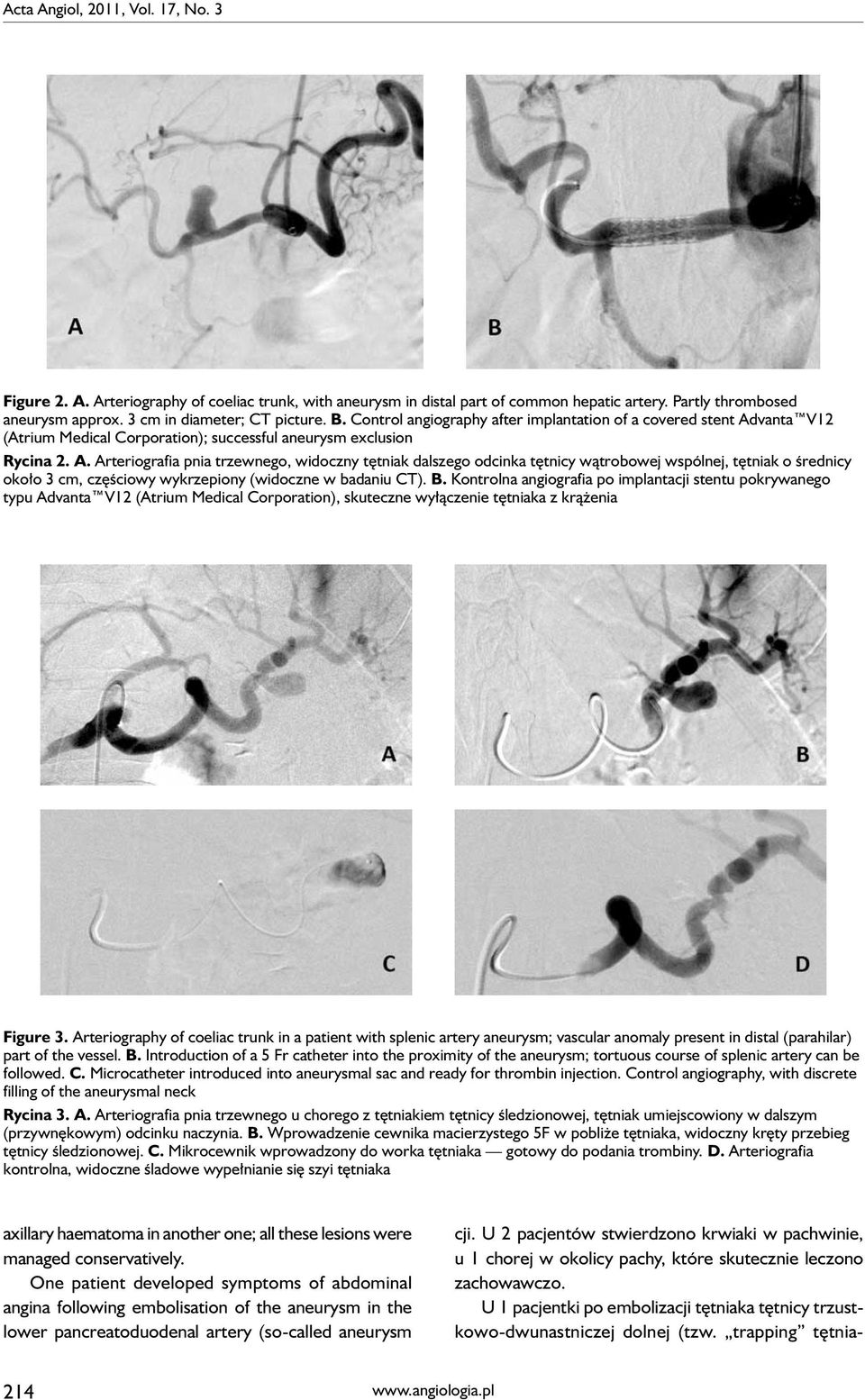 vanta V12 (Atrium Medical Corporation); successful aneurysm exclusion Rycina 2. A.