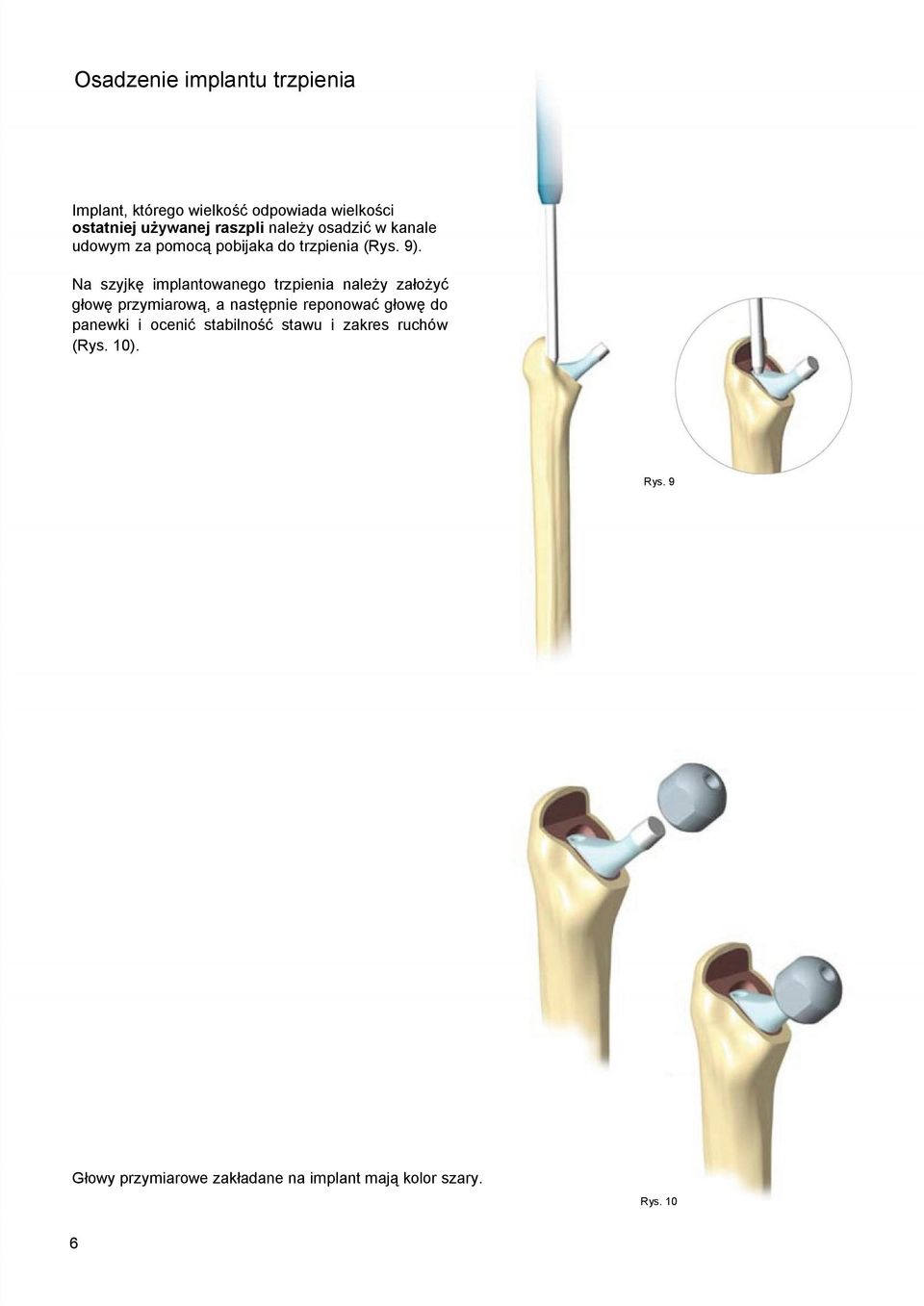 Na szyjkę implantowanego trzpienia należy założyć głowę przymiarową, a następnie reponować głowę do
