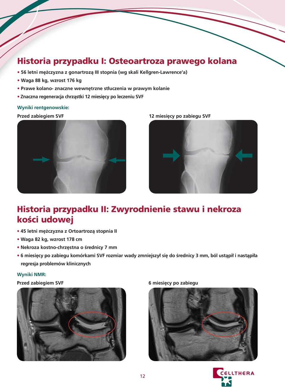 przypadku II: Zwyrodnienie stawu i nekroza kości udowej 45 letni mężczyzna z Ortoartrozą stopnia II Waga 82 kg, wzrost 178 cm Nekroza kostno-chrzęstna o średnicy 7 mm 6