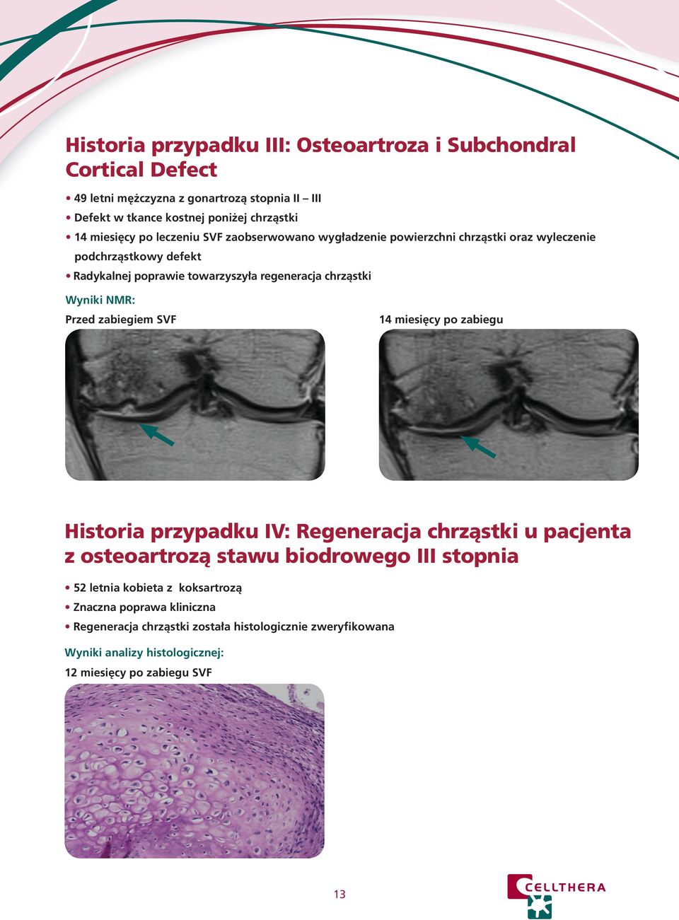 chrząstki Wyniki NMR: Przed zabiegiem SVF 14 miesięcy po zabiegu Historia przypadku IV: Regeneracja chrząstki u pacjenta z osteoartrozą stawu biodrowego III stopnia
