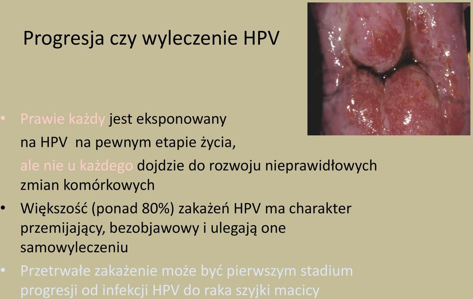 80%) zakażeo HPV ma charakter przemijający, bezobjawowy i ulegają one samowyleczeniu