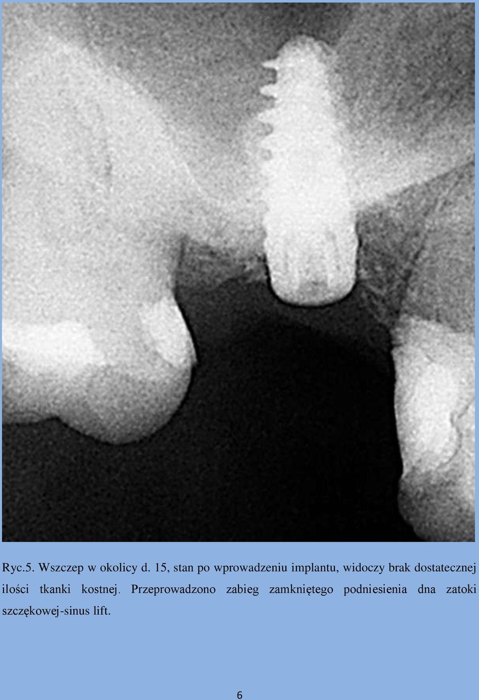 dostatecznej ilości tkanki kostnej.