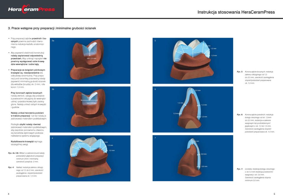 2,0 mm Preparacje ze ścięciem piórkowym krawędzi są nieodpowiednie dla odbudowy ceramicznej. Przy preparacji pod ceramikę prasowaną należy zapewnić minimalną grubość ścianek dla wkładów (bruzda) ok.