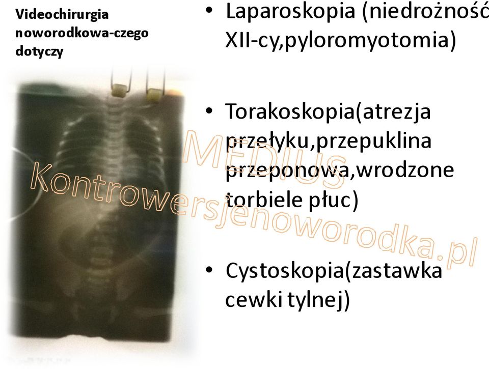 Torakoskopia(atrezja przełyku,przepuklina