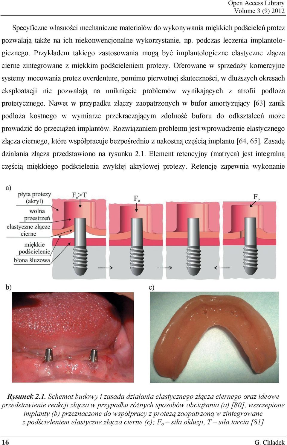 Oferowane w sprzeda y komercyjne systemy mocowania protez overdenture, pomimo pierwotnej skuteczno ci, w d u szych okresach eksploatacji nie pozwalaj na unikni cie problemów wynikaj cych z atrofii