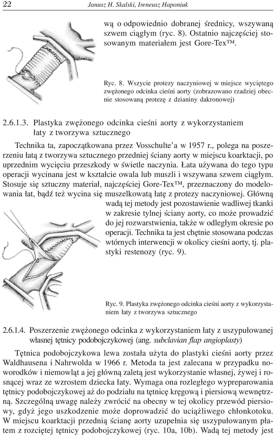 Wszycie protezy naczyniowej w miejsce wyciêtego zwê onego odcinka cieœni aorty (zobrazowano rzadziej obecnie stosowan¹ protezê z dzianiny dakronowej) 2.6.1.3.