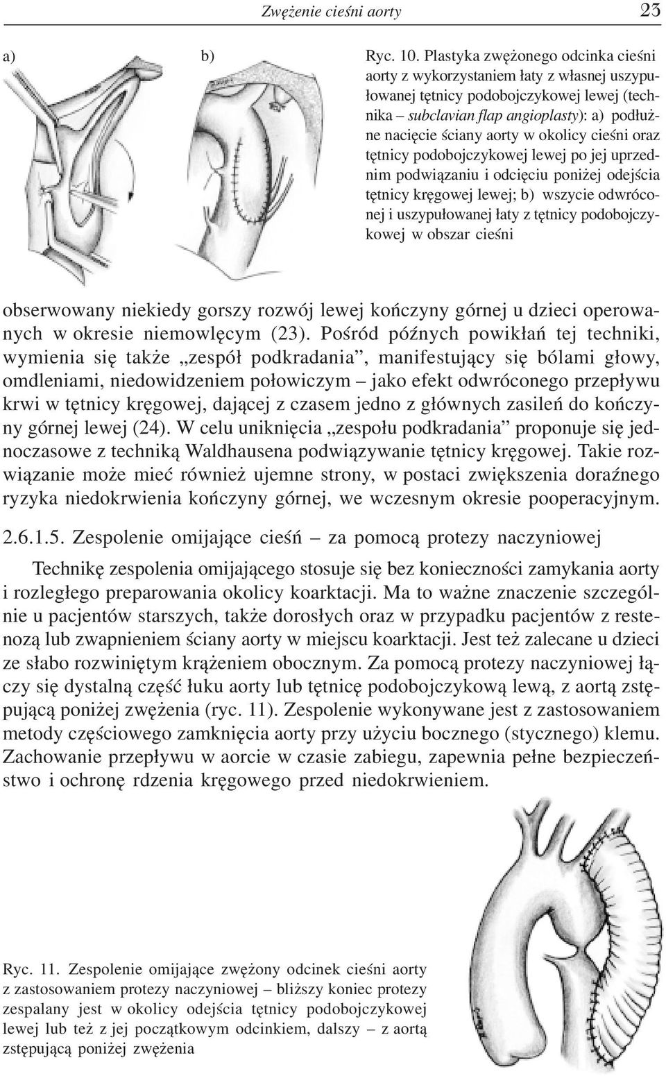 okolicy cieœni oraz têtnicy podobojczykowej lewej po jej uprzednim podwi¹zaniu i odciêciu poni ej odejœcia têtnicy krêgowej lewej; b) wszycie odwróconej i uszypu³owanej ³aty z têtnicy podobojczykowej