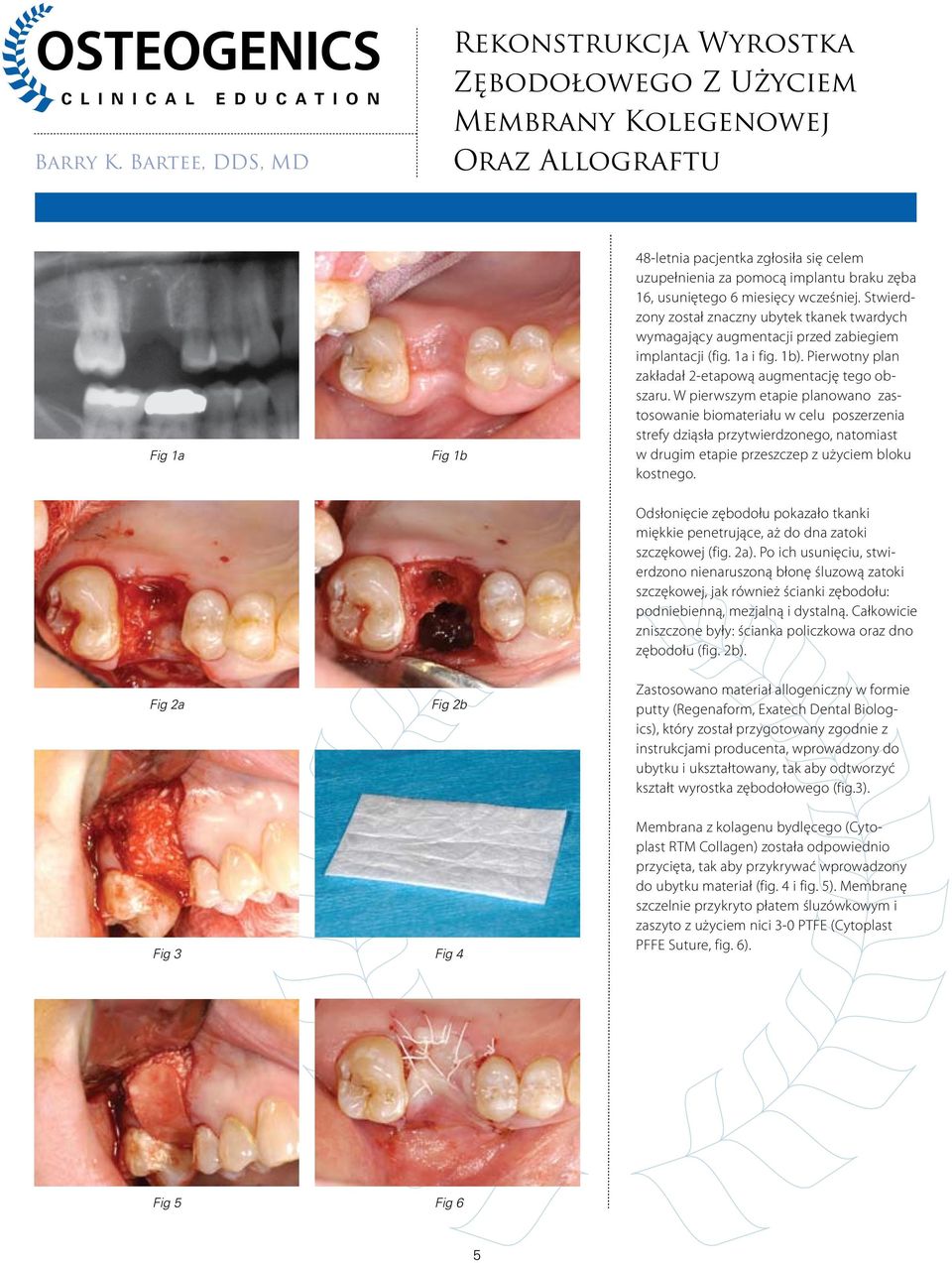 usuniętego 6 miesięcy wcześniej. Stwierdzony został znaczny ubytek tkanek twardych wymagający augmentacji przed zabiegiem implantacji (fig. 1a i fig. 1b).