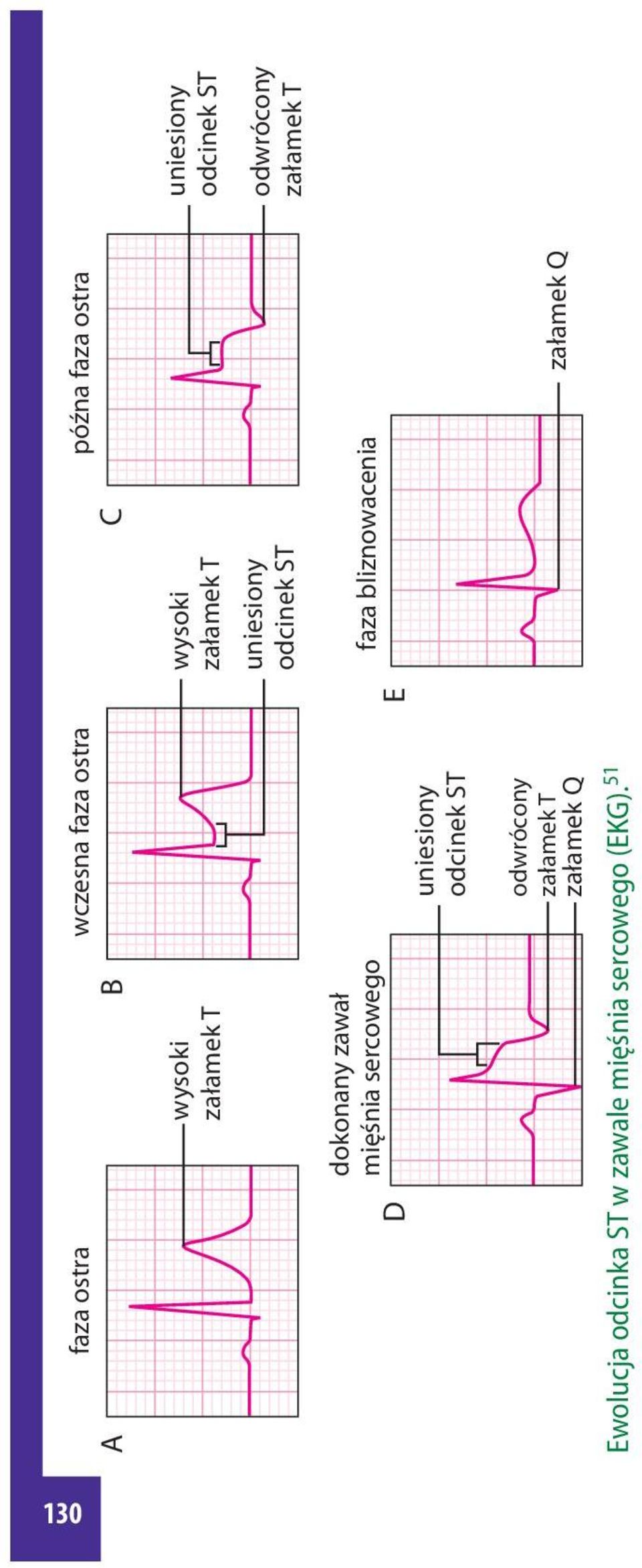 bliznowacenia D E uniesiony odcinek ST Ewolucja odcinka ST w zawale mięśnia