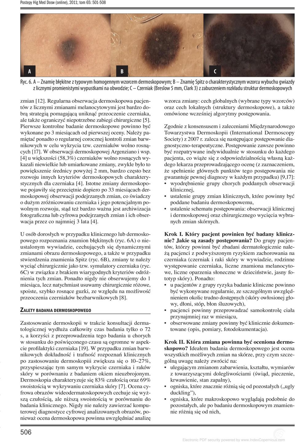 A Znamię błękitne z typowym homogennym wzorcem dermoskopowym; B Znamię Spitz o charakterystycznym wzorcu wybuchu gwiazdy z licznymi promienistymi wypustkami na obwodzie; C Czerniak (Breslow 5 mm,