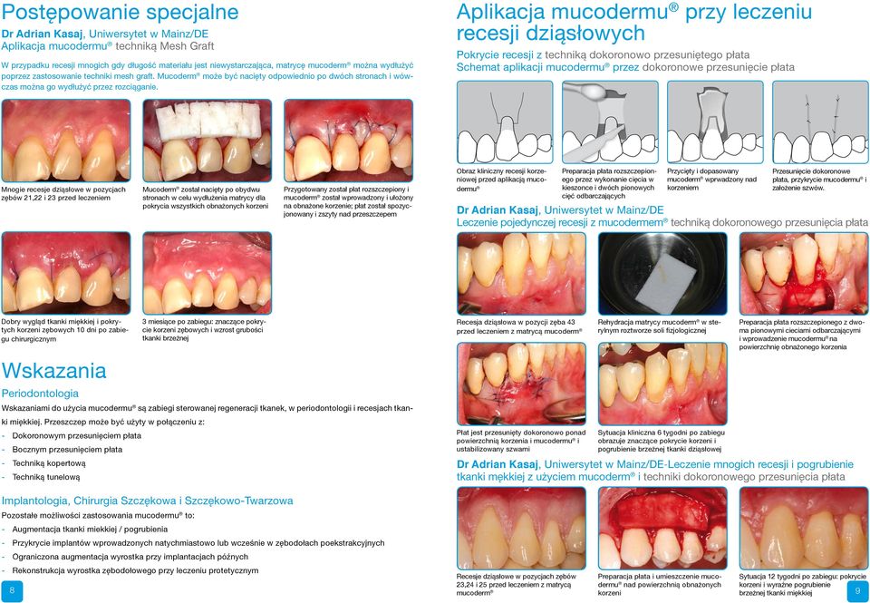 Aplikacja mucodermu przy leczeniu recesji dziąsłowych Pokrycie recesji z techniką dokoronowo przesuniętego płata Schemat aplikacji mucodermu przez dokoronowe przesunięcie płata Mnogie recesje