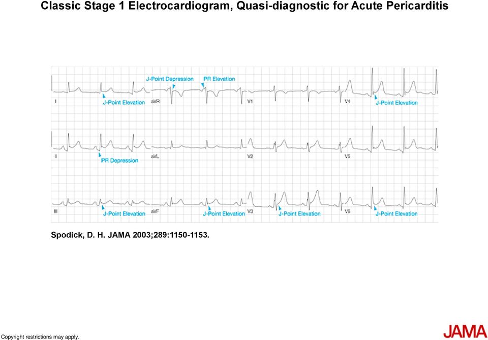 Pericarditis Spodick, D. H.