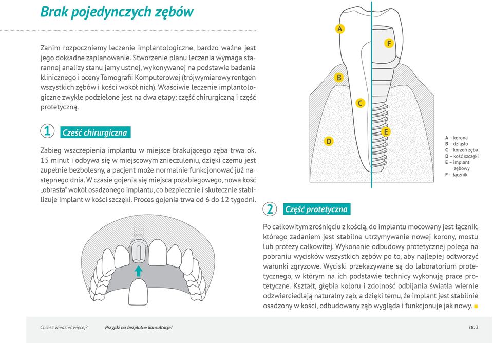 wokół nich). Właściwie leczenie implantologiczne zwykle podzielone jest na dwa etapy: część chirurgiczną i część protetyczną.