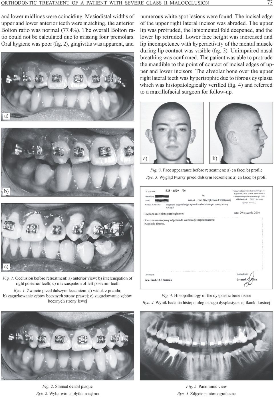 Oral hygiene was poor (fig. 2), gingivitis was apparent, and numerous white spot lesions were found. The incisal edge of the upper right lateral incisor was abraded.