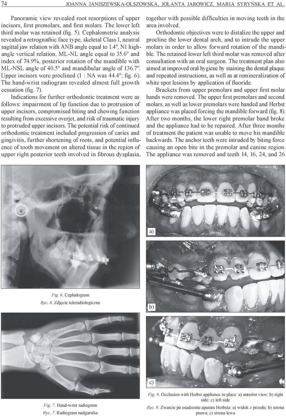 4, N1 highangle vertical relation, ML-NL angle equal to 35.6 and index of 74.9%, posterior rotation of the mandible with ML-NSL angle of 40.5 and mandibular angle of 136.7. Upper incisors were proclined (1 : NA was 44.