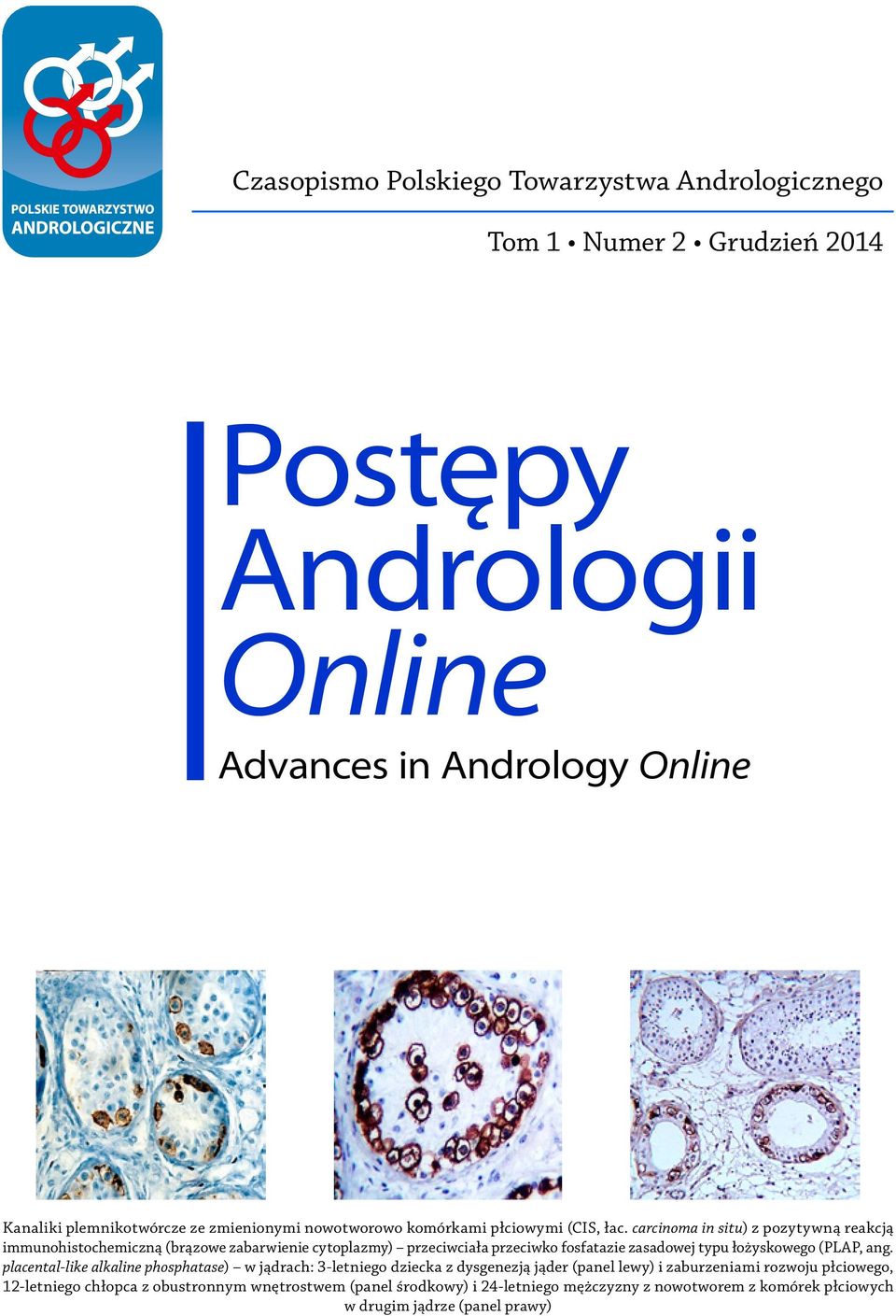 carcinoma in situ) z pozytywną reakcją immunohistochemiczną (brązowe zabarwienie cytoplazmy) przeciwciała przeciwko fosfatazie zasadowej typu łożyskowego (PLAP, ang.