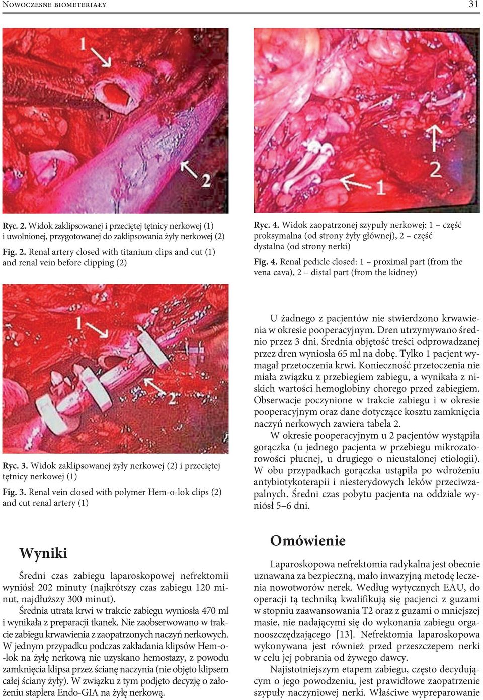 Renal pedicle closed: 1 proximal part (from the vena cava), 2 distal part (from the kidney) Ryc. 3.