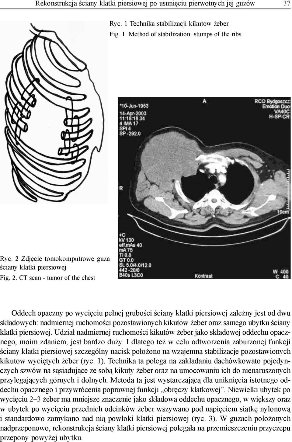 CT scan - tumor of the chest Oddech opaczny po wycięciu pełnej grubości ściany klatki piersiowej zależny jest od dwu składowych: nadmiernej ruchomości pozostawionych kikutów żeber oraz samego ubytku