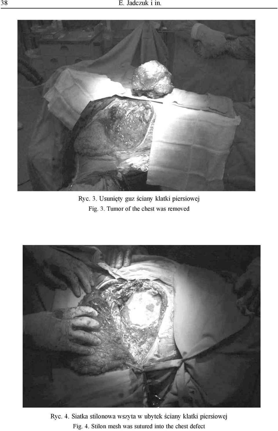 Tumor of the chest was removed Ryc. 4.