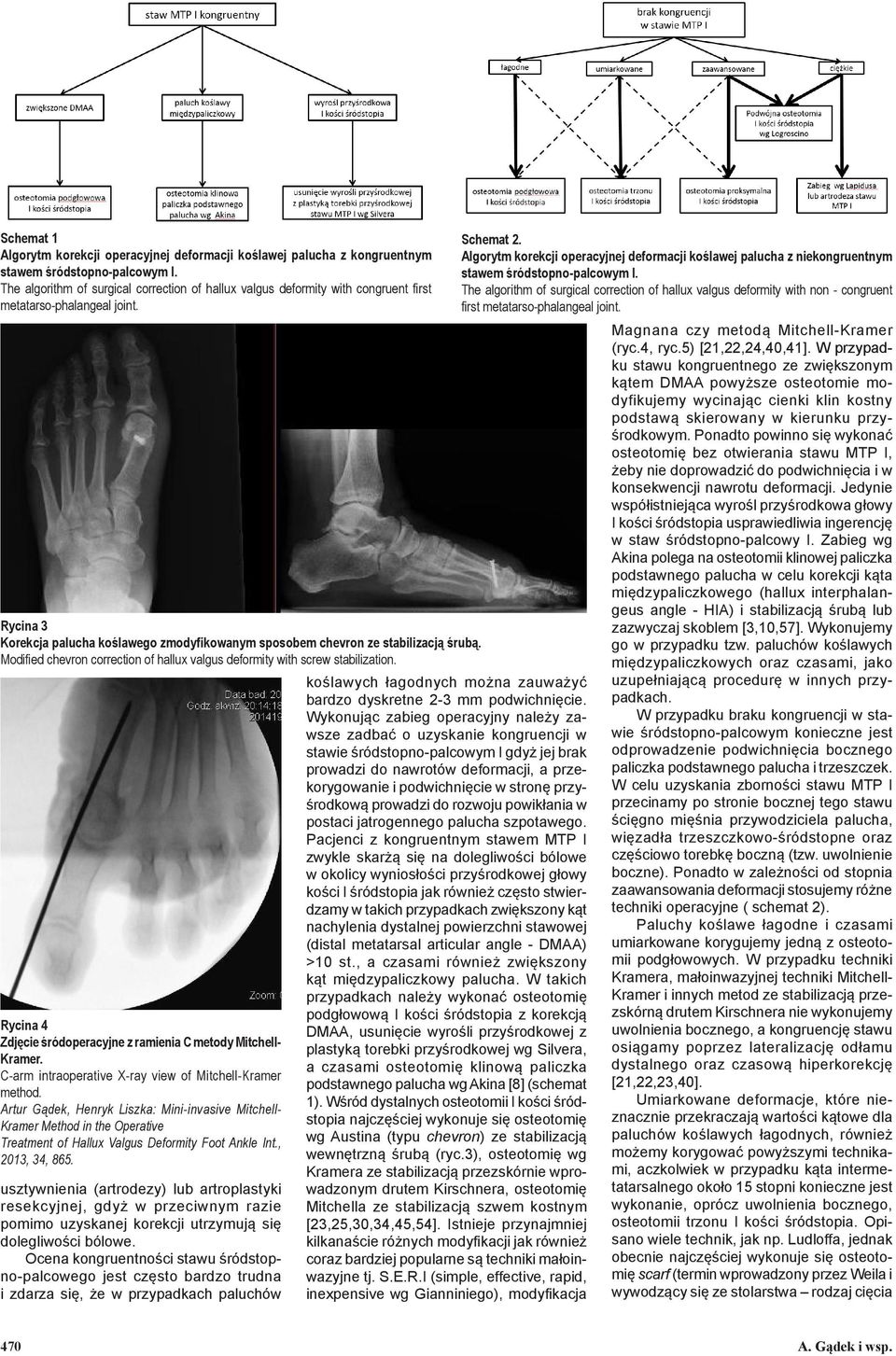 Rycina 3 Korekcja palucha koślawego zmodyfikowanym sposobem chevron ze stabilizacją śrubą. Modified chevron correction of hallux valgus deformity with screw stabilization.