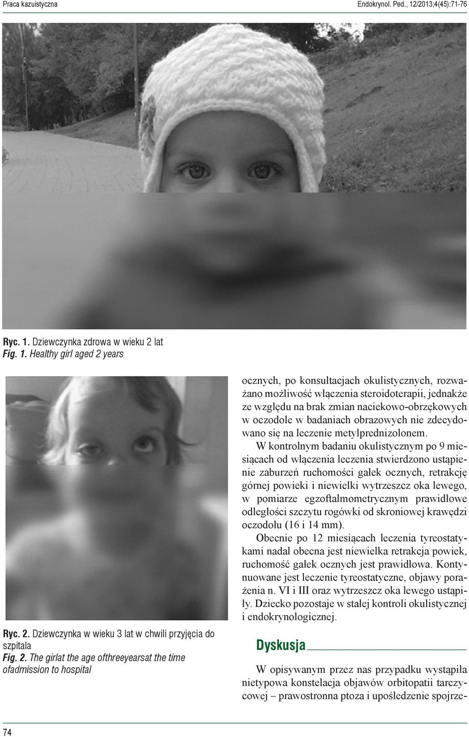 naciekowo-obrzękowych w oczodole w badaniach obrazowych nie zdecydowano się na leczenie metylprednizolonem.