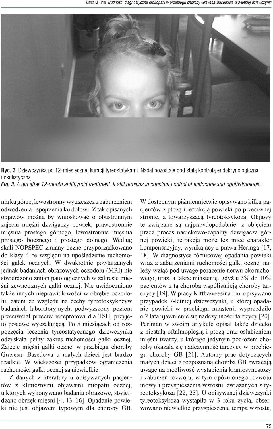 It still remains in constant control of endocrine and ophthalmologic nia ku górze, lewostronny wytrzeszcz z zaburzeniem odwodzenia i spojrzenia ku dołowi.