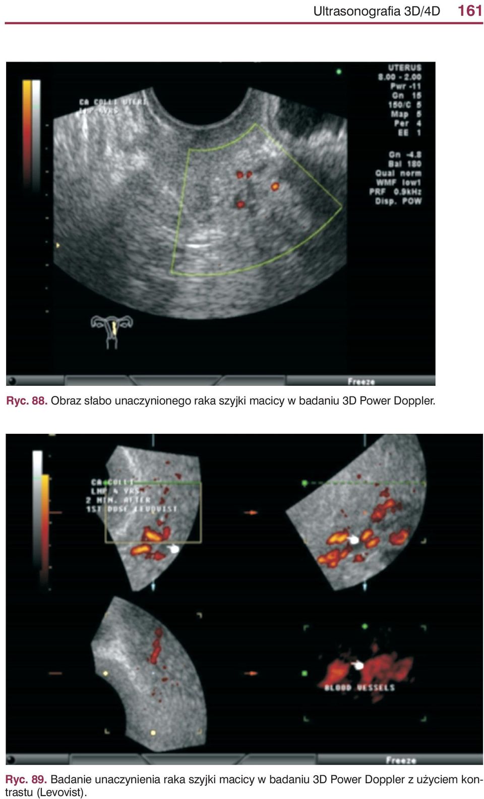 badaniu 3D Power Doppler. Ryc. 89.