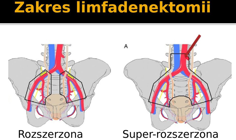 Node Dissection in Patients Undergoing Radical Cystectomy for