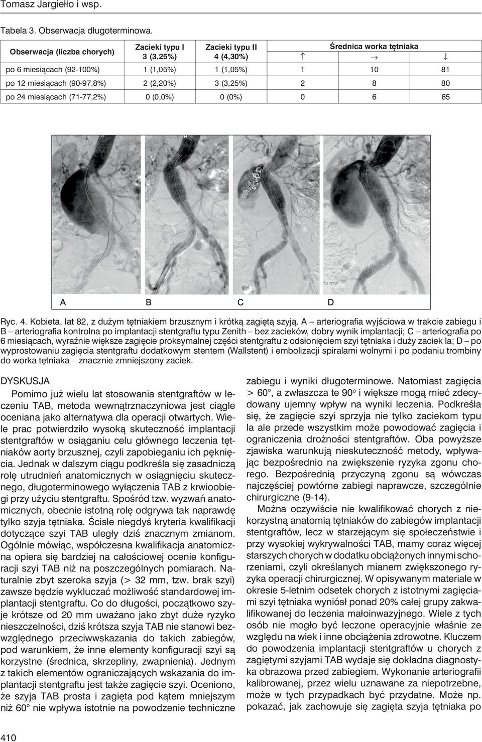 (3,25%) 2 8 80 po 24 miesiącach (71-77,2%) 0 (0,0%) 0 (0%) 0 6 65 Ryc. 4. Kobieta, lat 82, z dużym tętniakiem brzusznym i krótką zagiętą szyją.