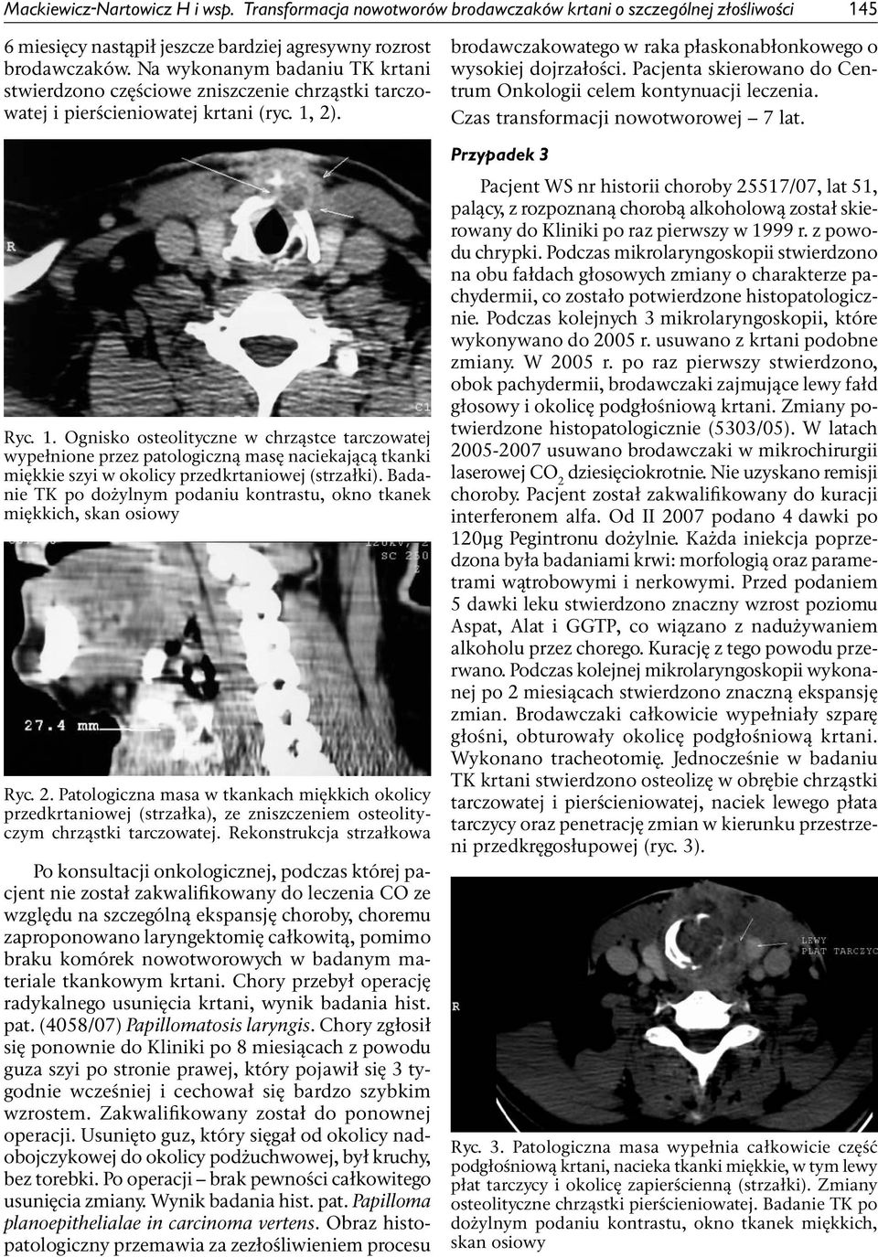 2). Ryc. 1. Ognisko osteolityczne w chrząstce tarczowatej wypełnione przez patologiczną masę naciekającą tkanki miękkie szyi w okolicy przedkrtaniowej (strzałki).