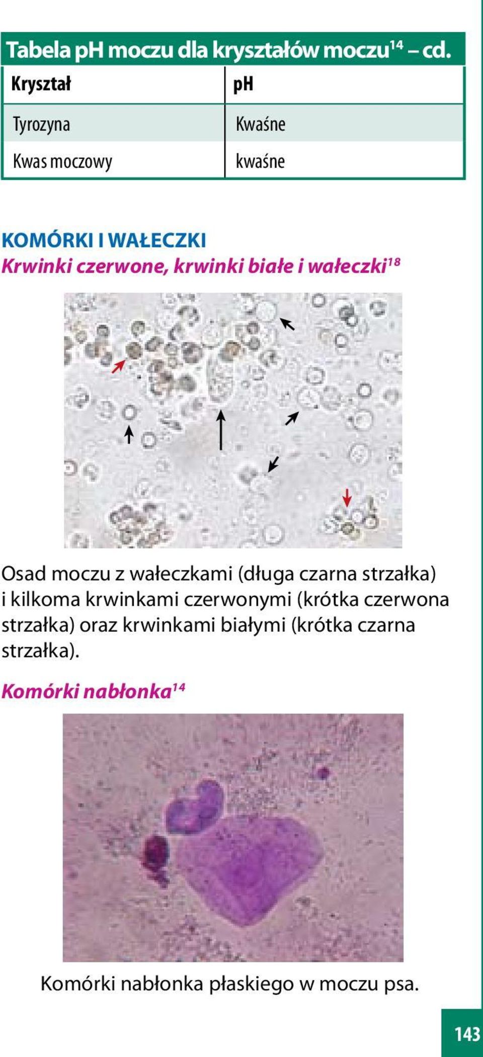 białe i wałeczki 18 Osad moczu z wałeczkami (długa czarna strzałka) i kilkoma krwinkami