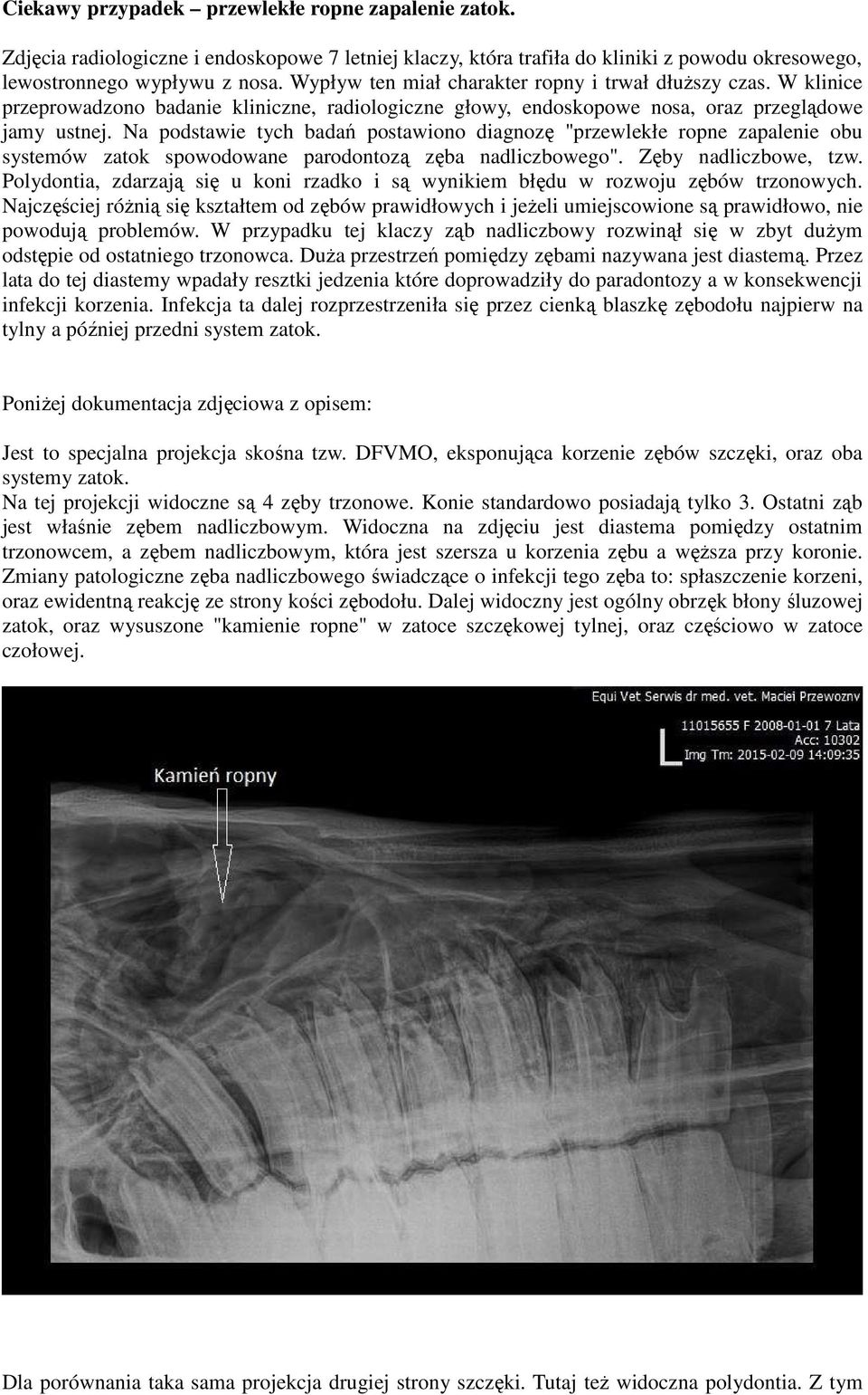 Na podstawie tych badań postawiono diagnozę "przewlekłe ropne zapalenie obu systemów zatok spowodowane parodontozą zęba nadliczbowego". Zęby nadliczbowe, tzw.