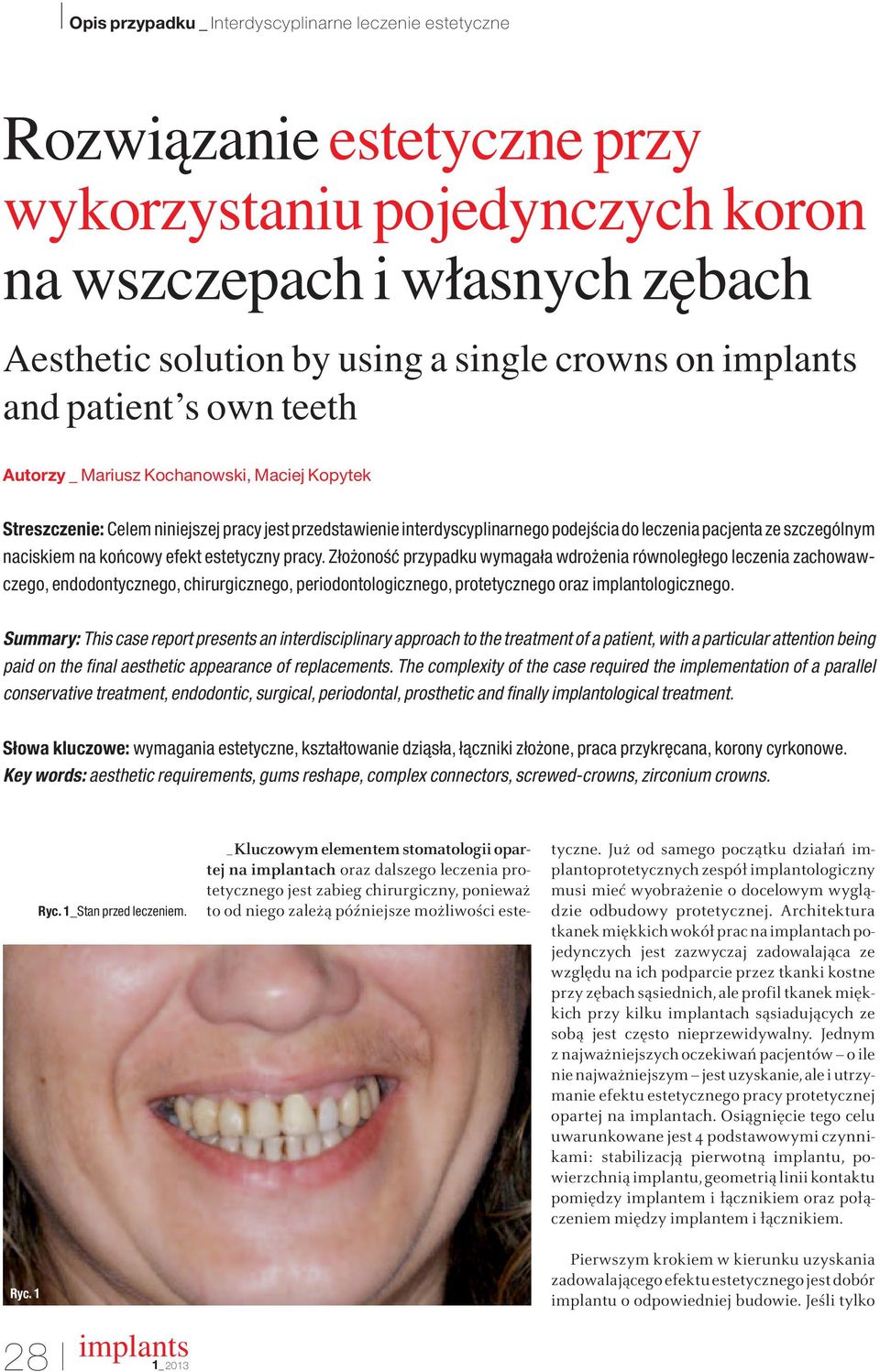 Zło onoêç przypadku wymagała wdro enia równoległego leczenia zachowawczego, endodontycznego, chirurgicznego, periodontologicznego, protetycznego oraz implantologicznego.