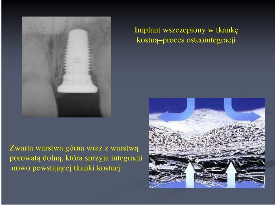 nowo powstającej tkanki kostnej Implant