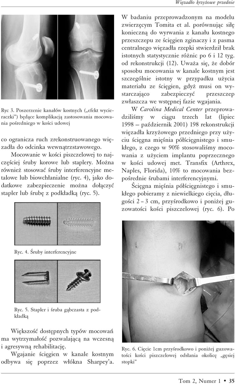 Mocowanie w ko ci piszczelowej to najczæ ciej ruby korowe lub staplery. Moºna równieº stosowaì ruby interferencyjne metalowe lub biowchæanialne (ryc.