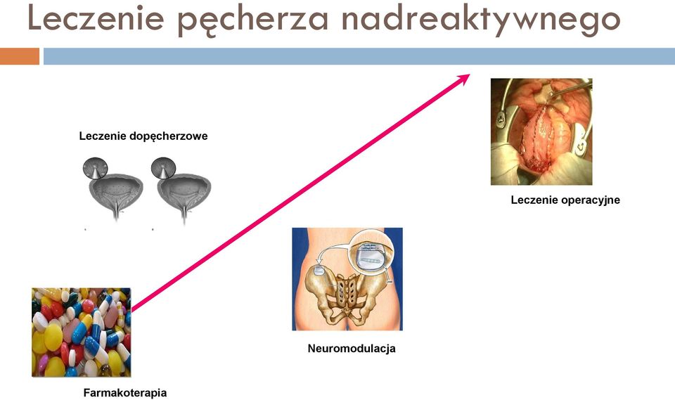 dopęcherzowe Leczenie