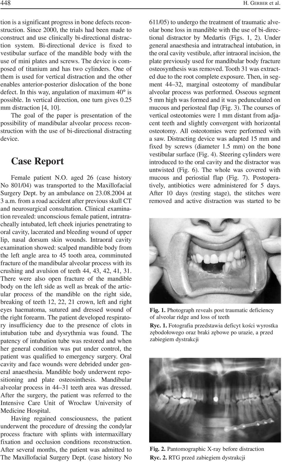 One of them is used for vertical distraction and the other enables anterior posterior dislocation of the bone defect. In this way, angulation of maximum 40 is possible.