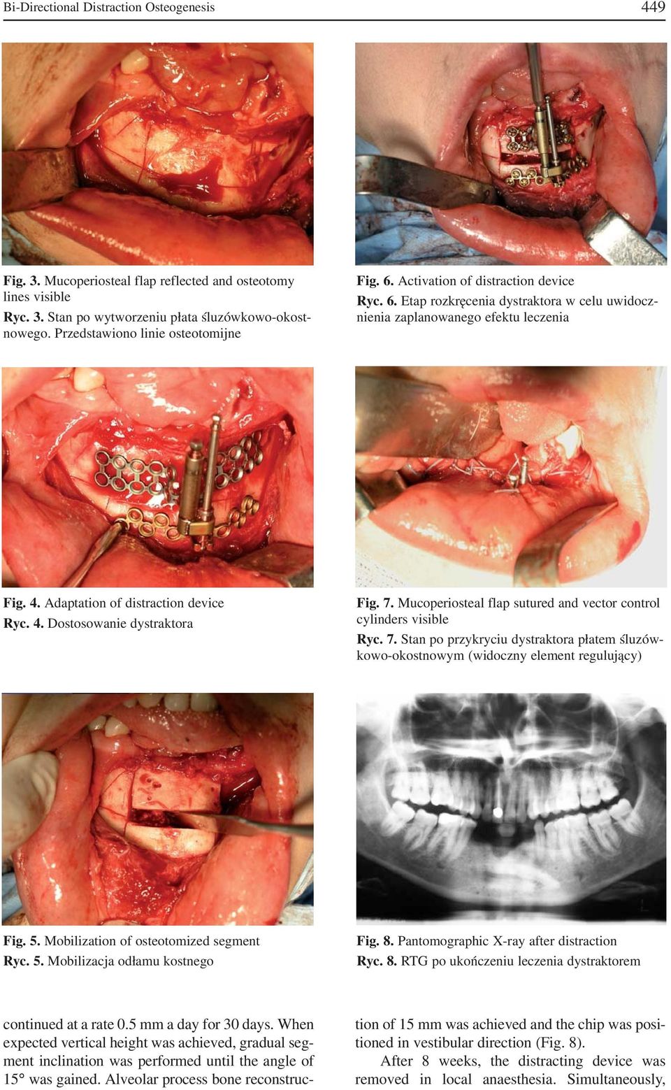 Adaptation of distraction device Ryc. 4. Dostosowanie dystraktora Fig. 7. Mucoperiosteal flap sutured and vector control cylinders visible Ryc. 7. Stan po przykryciu dystraktora płatem śluzów kowo okostnowym (widoczny element regulujący) Fig.