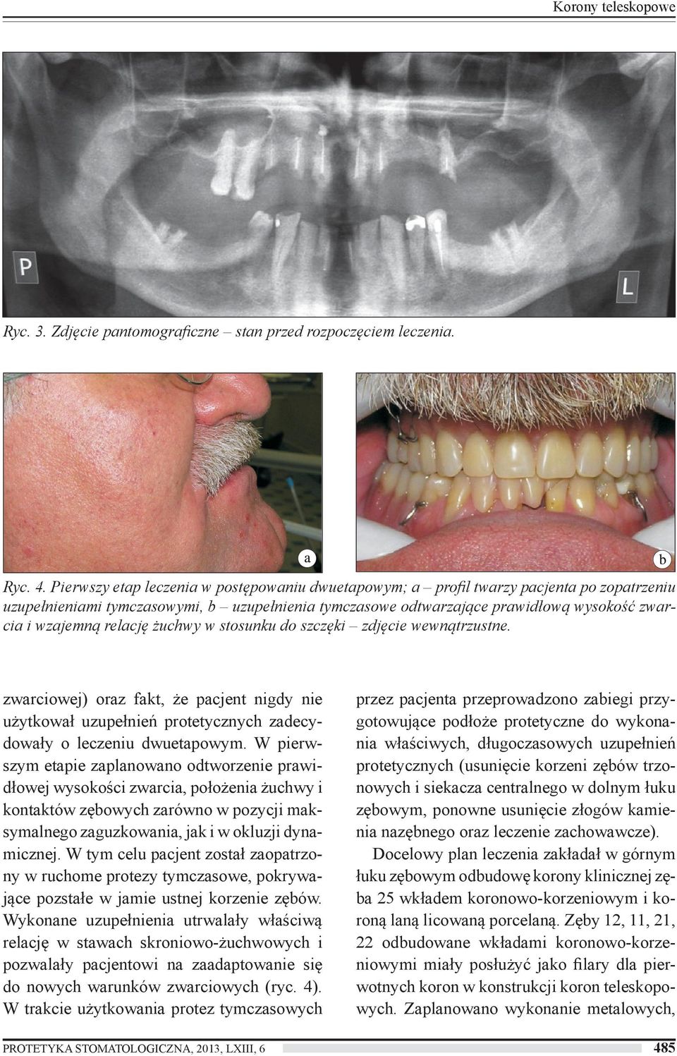 relację żuchwy w stosunku do szczęki zdjęcie wewnątrzustne. zwarciowej) oraz fakt, że pacjent nigdy nie użytkował uzupełnień protetycznych zadecydowały o leczeniu dwuetapowym.