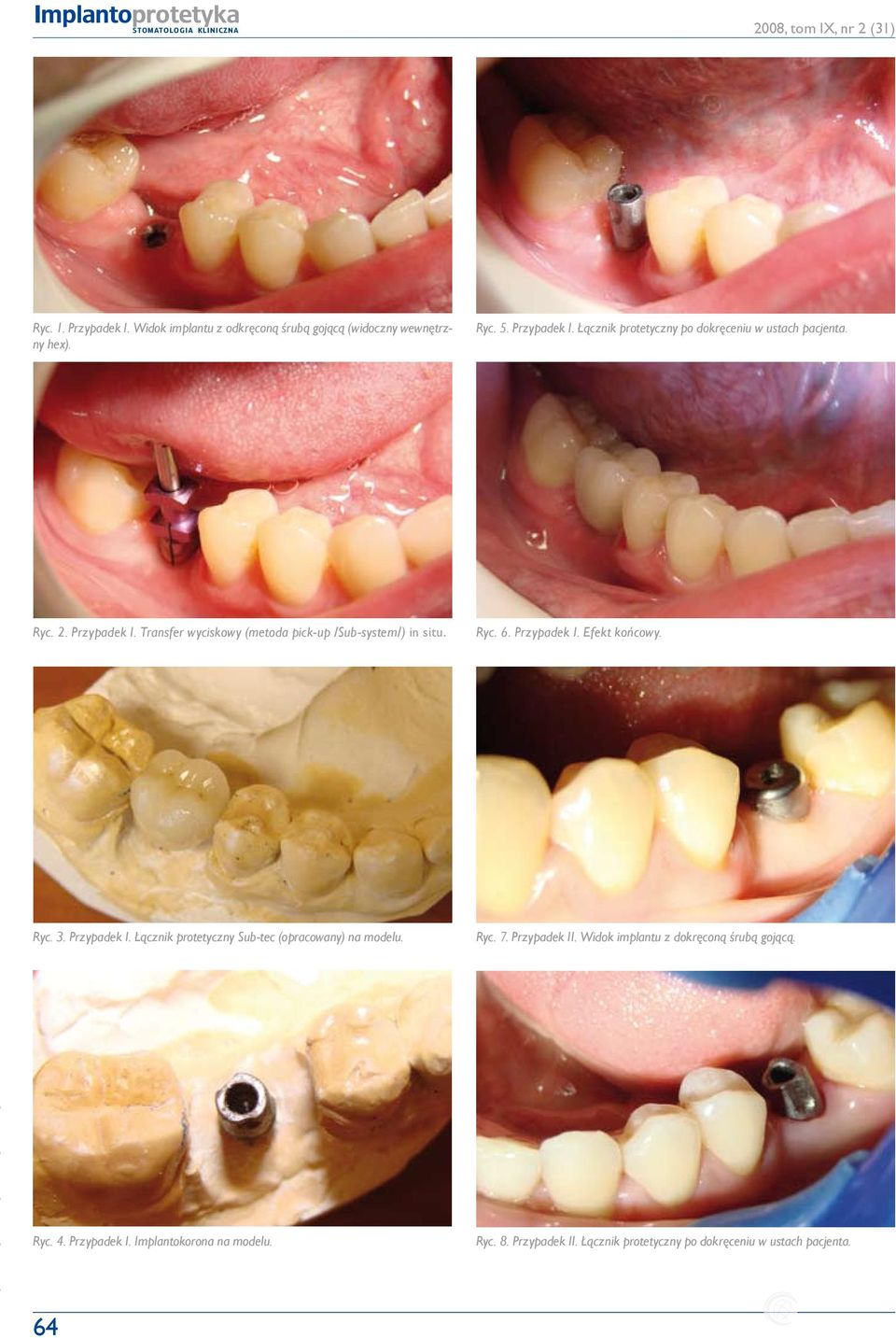 Ryc. 7. Przypadek II. Widok implantu z dokręconą śrubą gojącą. Ryc. 4. Przypadek I. Implantokorona na modelu. 64 Ryc. 8. Przypadek II. Łącznik protetyczny po dokręceniu w ustach pacjenta.