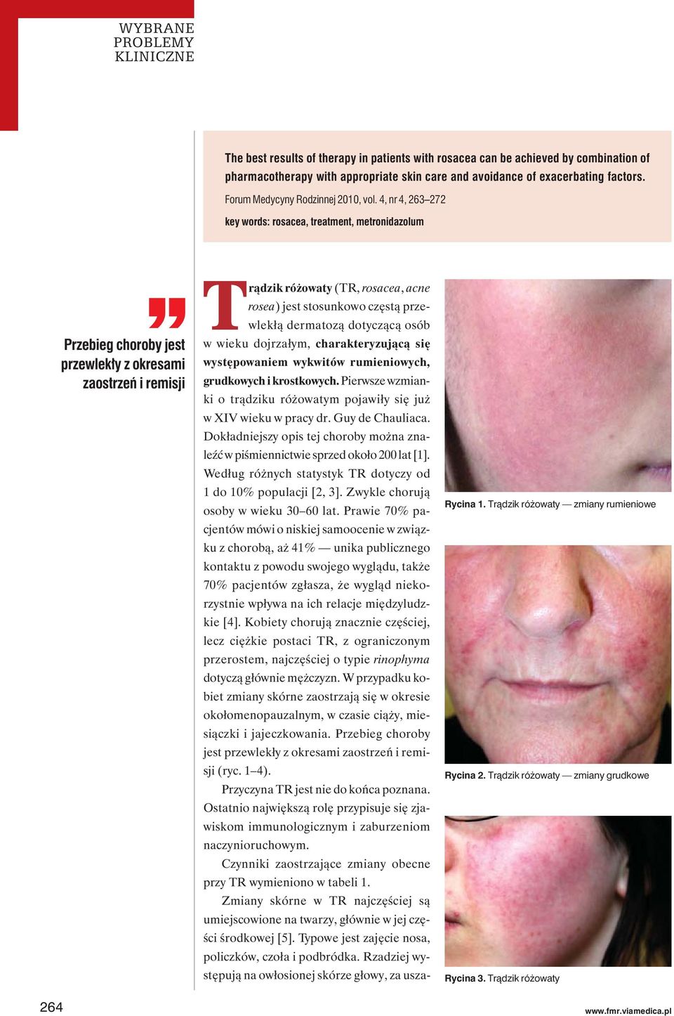 4, nr 4, 263 272 key words: rosacea, treatment, metronidazolum Przebieg choroby jest przewlekły z okresami zaostrzeń i remisji Trądzik różowaty (TR, rosacea, acne rosea) jest stosunkowo częstą