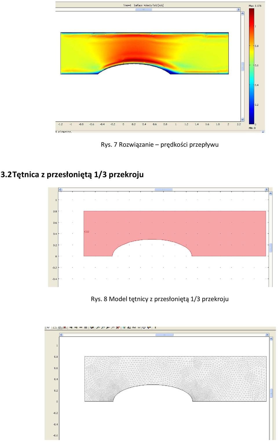 2 Tętnica z przesłoniętą 1/3