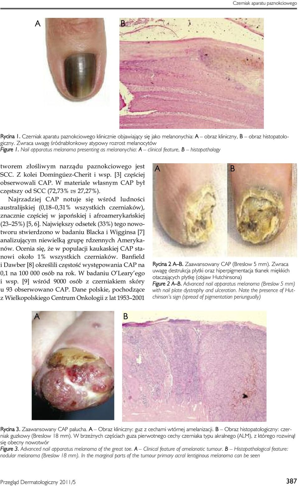 Nail apparatus melanoma presenting as melanonychia: A clinical feature, B histopathology tworem złośliwym narządu paznokciowego jest SCC. Z kolei Domíngúez-Cherit i wsp. [3] częściej obserwowali CAP.