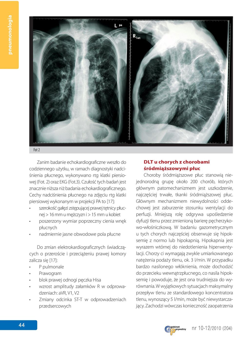 Cechy nadciśnienia płucnego na zdjęciu rtg klatki piersiowej wykonanym w projekcji PA to [17]: szerokość gałęzi zstępującej prawej tętnicy płucnej > 16 mm u mężczyzn i > 15 mm u kobiet poszerzony