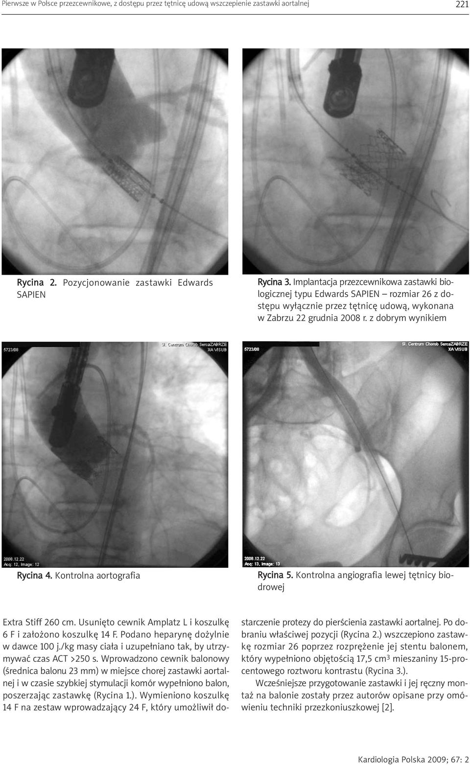 Kontrolna aortografia Rycina 5. Kontrolna angiografia lewej tętnicy biodrowej Extra Stiff 260 cm. Usunięto cewnik Amplatz L i koszulkę 6 F i założono koszulkę 14 F.